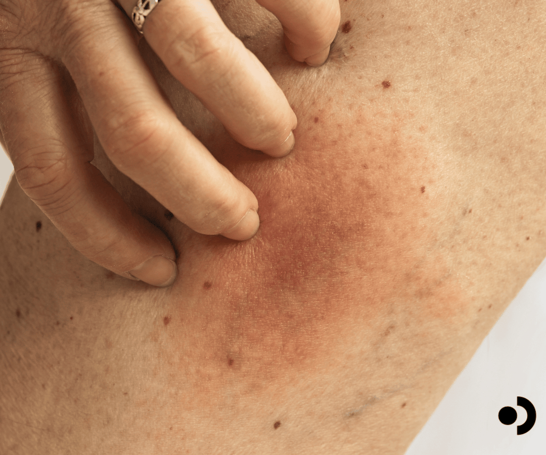Understanding Allergic Reactions From Insects: A Scientific Overview