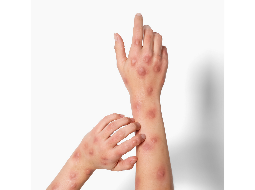 Heat Rash: Treatment and Prevention
