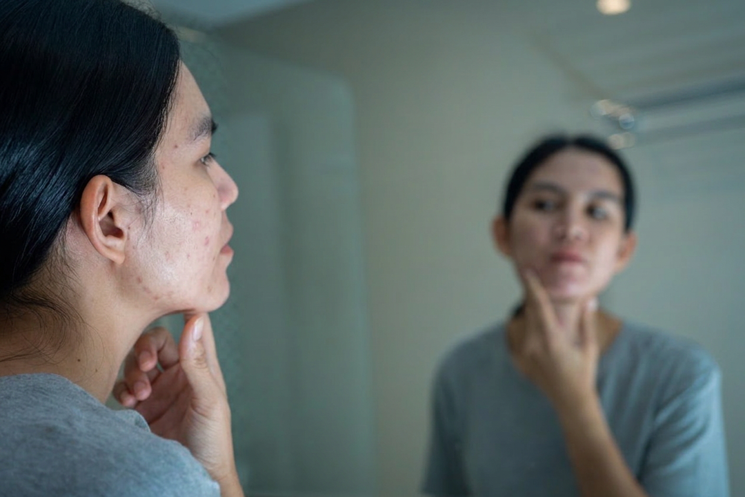 Anti-Itch Cream: Choosing the Right Relief for Your Skin