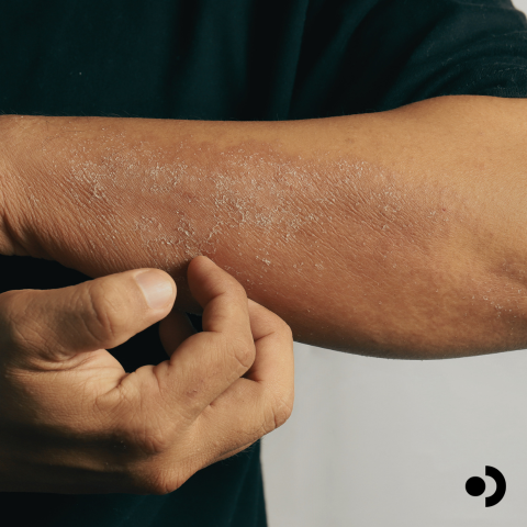Itchy skin